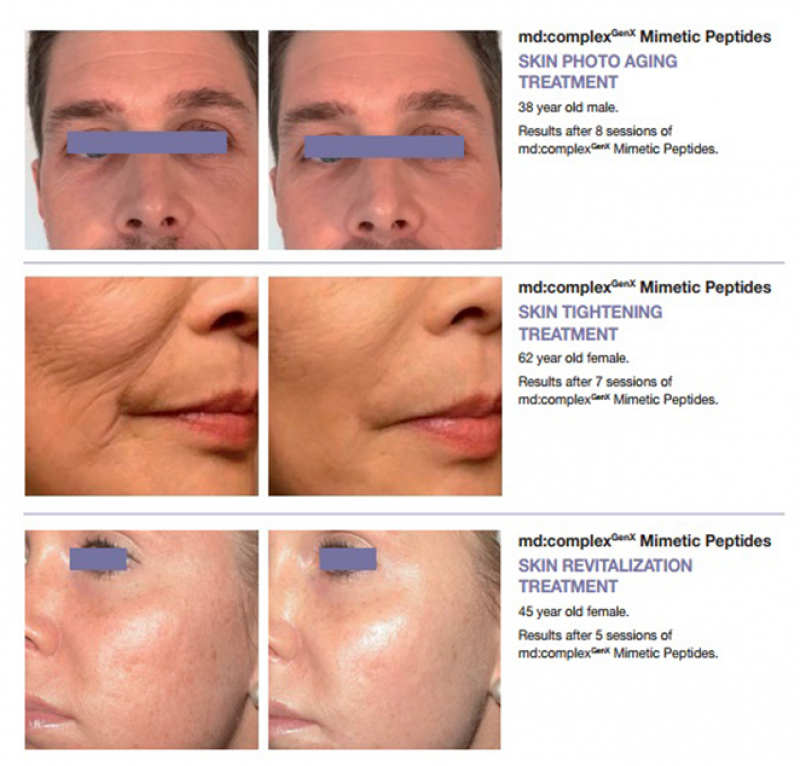 Tế bào gốc tăng trưởng tái tạo và trẻ hóa da toàn diện Md:ceuticals Md Complex Genx Mimetic Peptides & Growth Factor